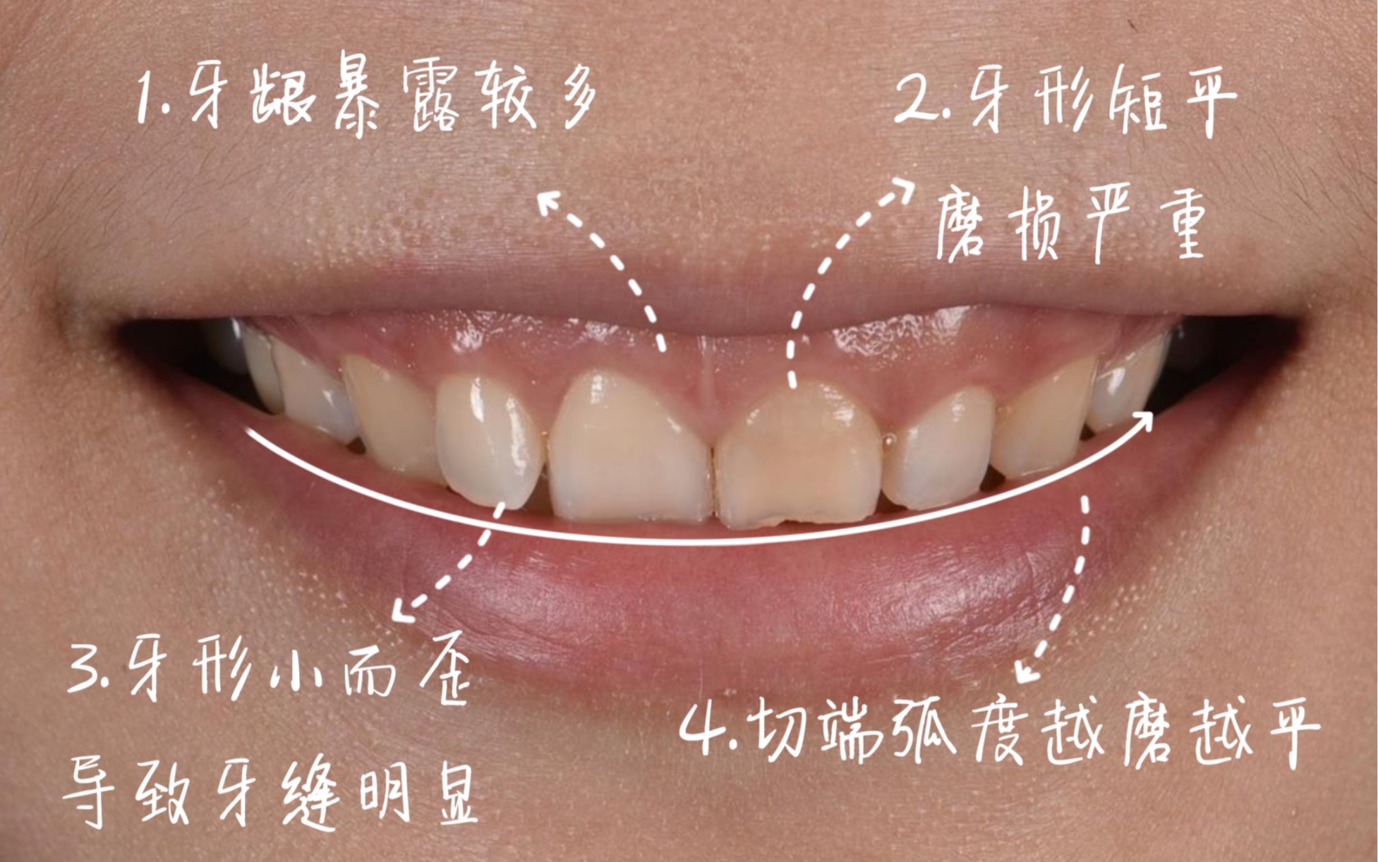 冠延长术的图解图片