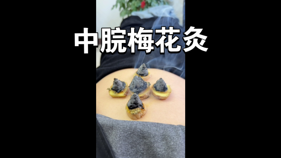 做5个倒流烟艾塔做中脘梅花灸
