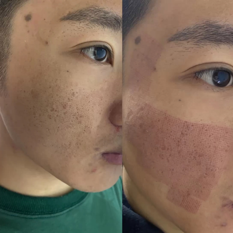 男生激光治疗痘印痘坑全过程看后期恢复情况
