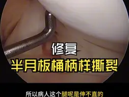 Download Video: 怎么修复半月板桶柄样撕裂？