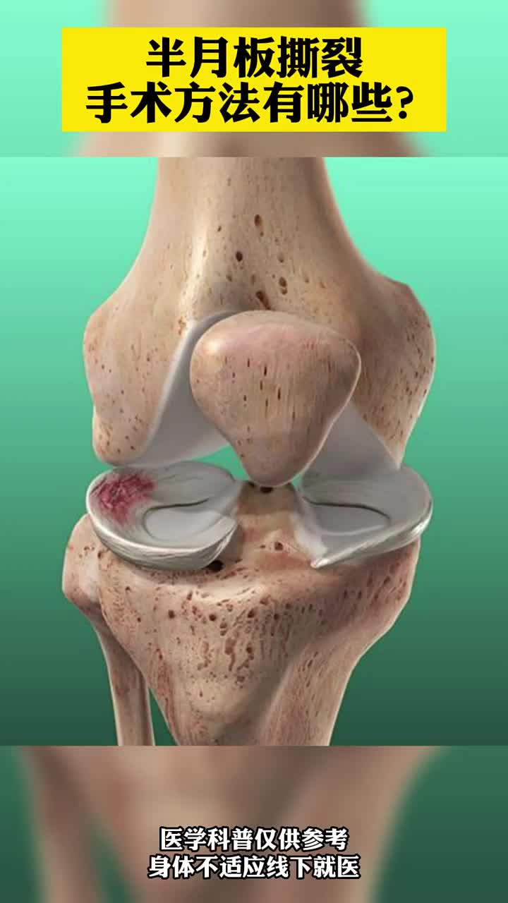 半月板撕裂手术方法有哪些?