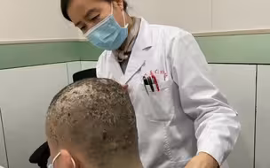 10年头皮银屑病严重不自知，剃完头发惊呆了