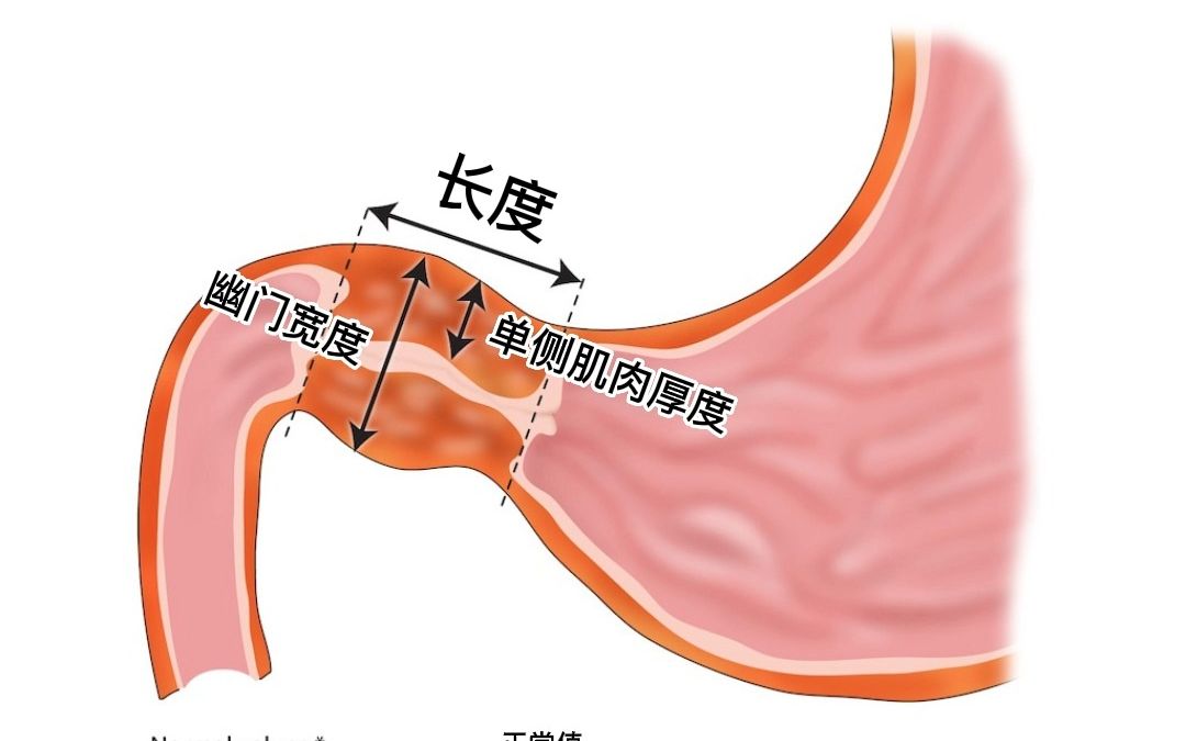 儿童幽门梗阻图片