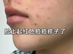 Download Video: 头油，掉发严重，脂溢性皮炎一定要重视！