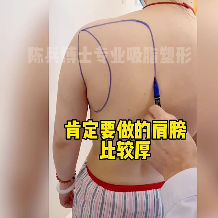 如何改善虎背熊腰的形态?背部抽脂真人讲述哔哩哔哩bilibili