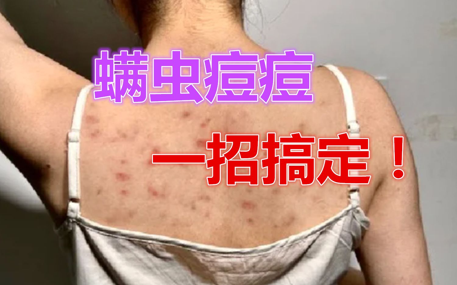 后背长痘很困扰!原来是螨虫安了窝!除螨祛痘只需要简单四步搞定!