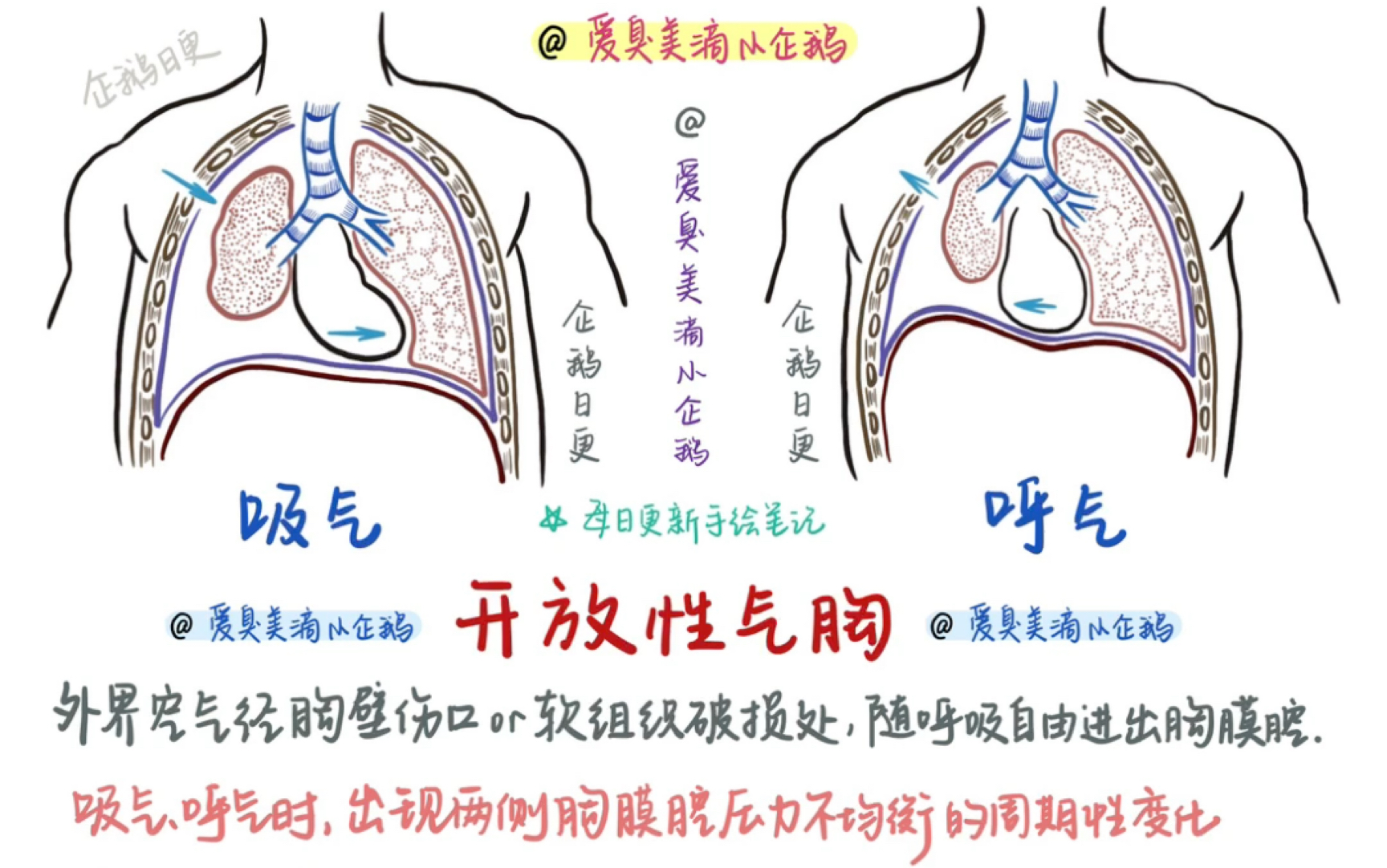 开放性气胸【纵隔扑动】(红薯每日更新:爱臭美滴小企鹅)哔哩哔哩bilibili