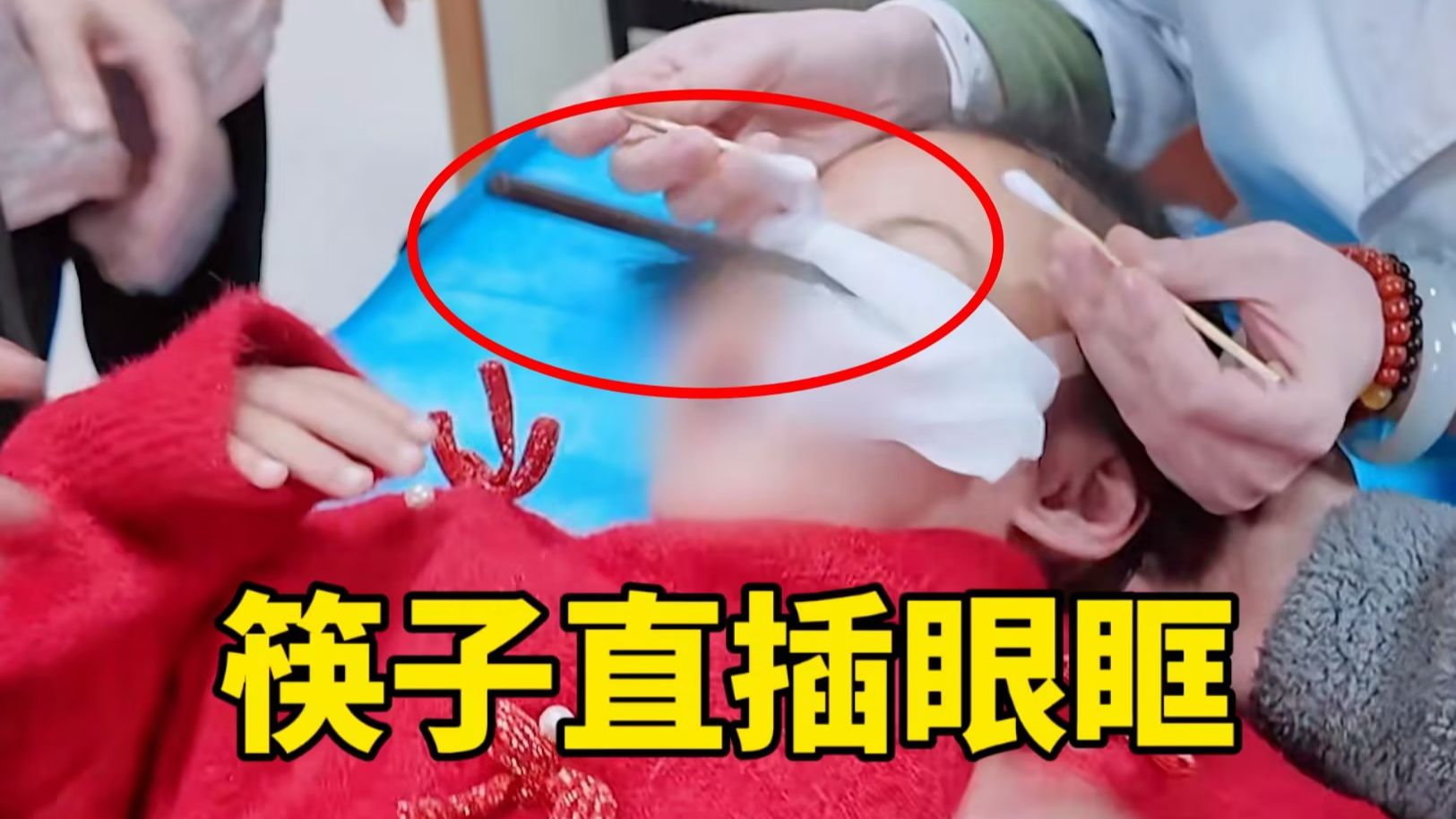 【慎入】5岁女童摔倒，筷子不慎插入眼眶？