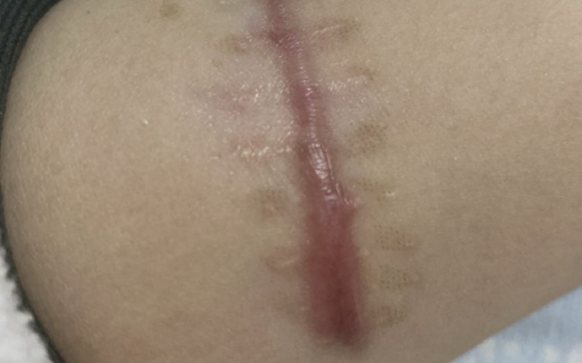 手术后疤痕发红鼓起来图片