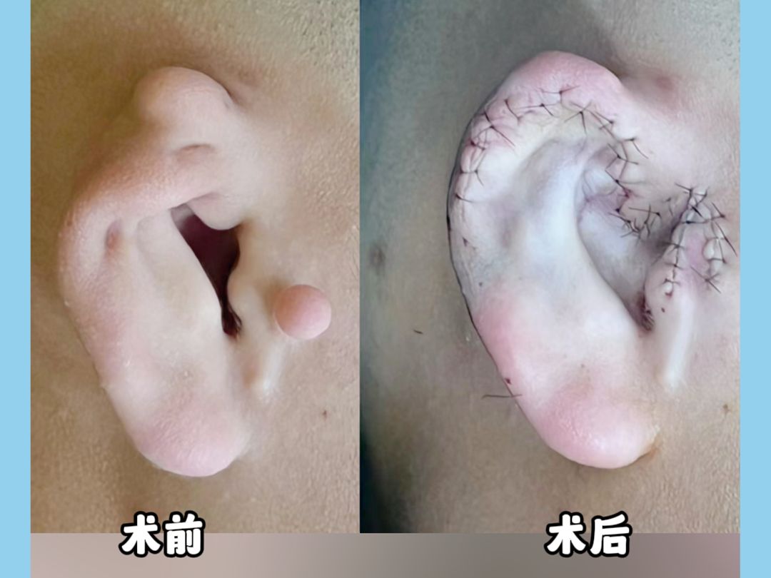 双侧小耳畸形同时舒展做出对称大耳朵,医生帮他节省几万块!