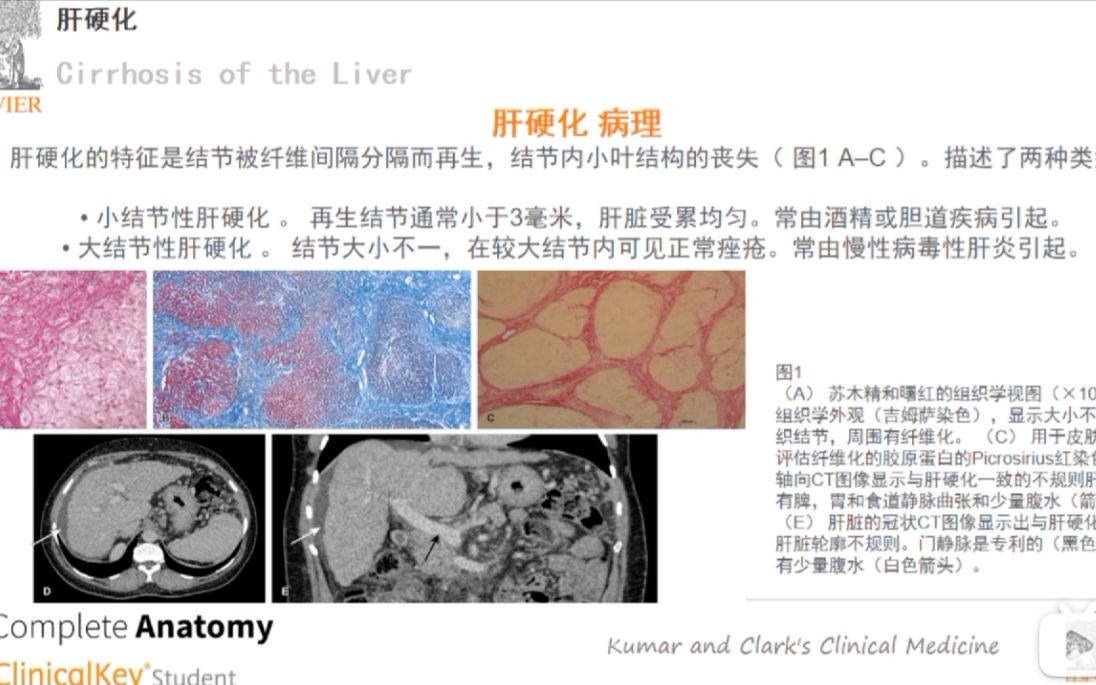 【第二届PBL医学脱口秀】肝硬化陈淑仪和马彬力哔哩哔哩bilibili