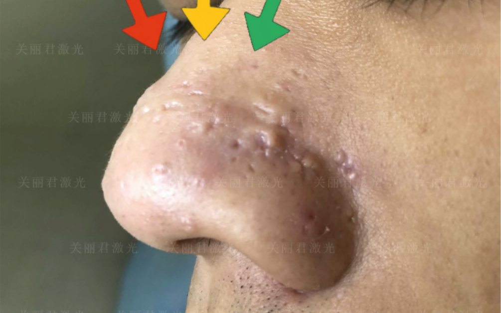 鼻头增生加凹陷的痘疤修复治疗