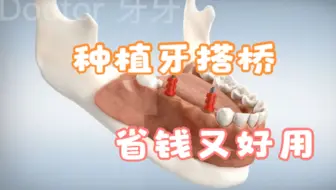 多颗牙缺失了解下种植牙搭桥，省钱又好用，动画科普是怎样的过程