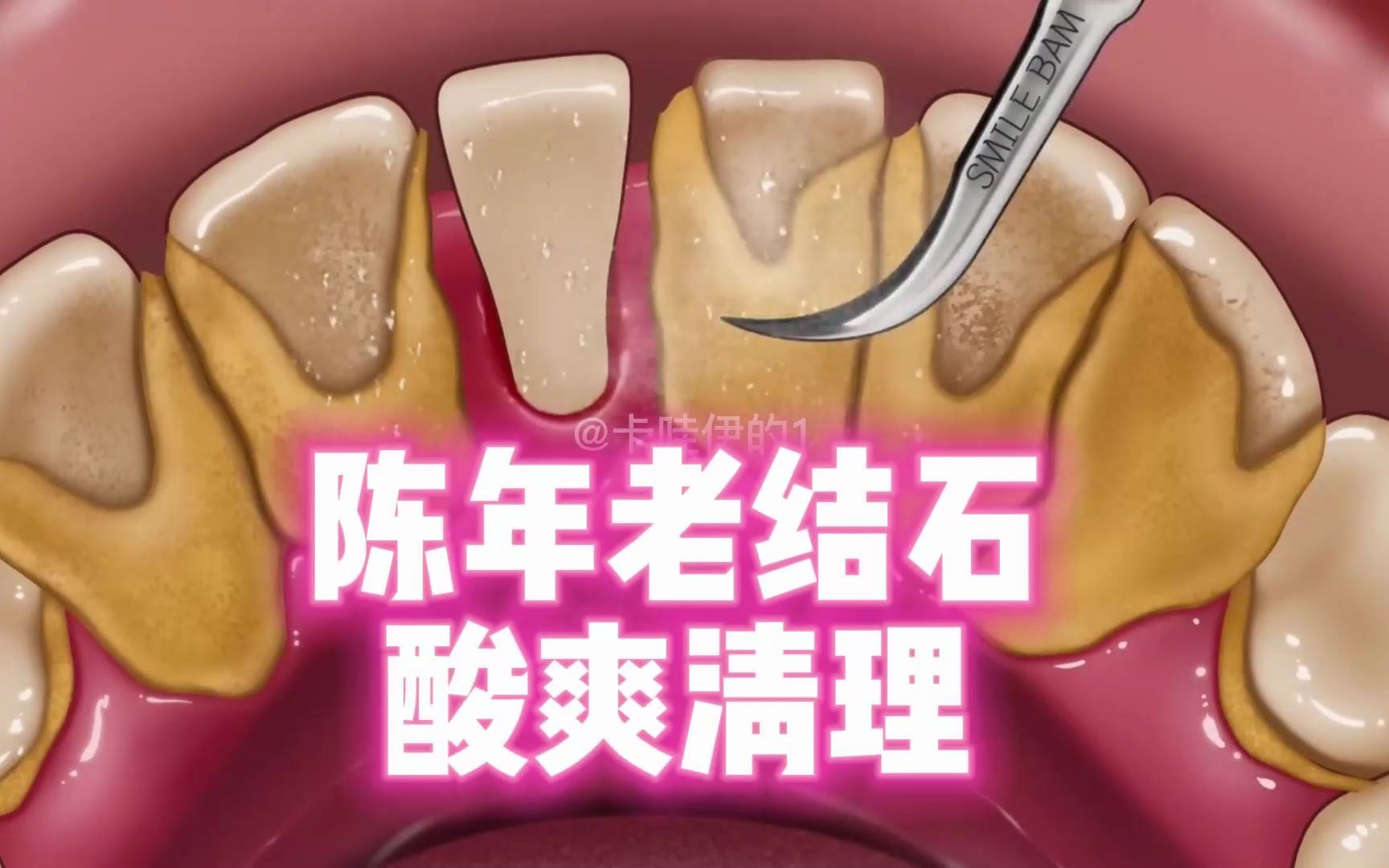 清理牙结石的方法图片