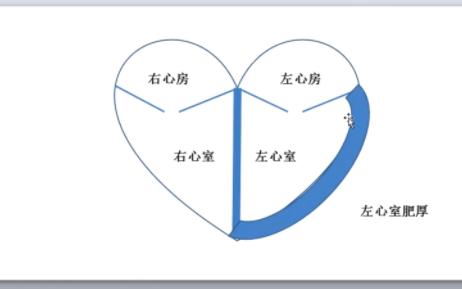 左心室肥厚及心电图表现哔哩哔哩bilibili