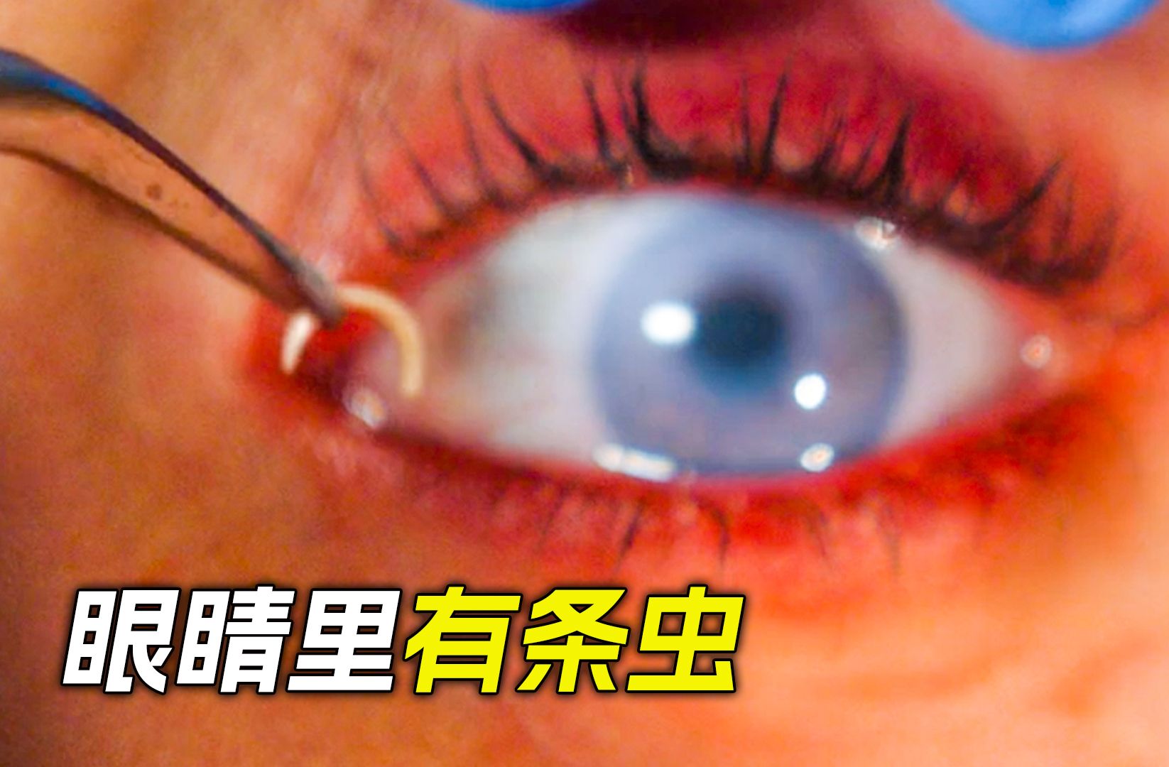 女人眼里有条虫子,导致看什么都很模糊