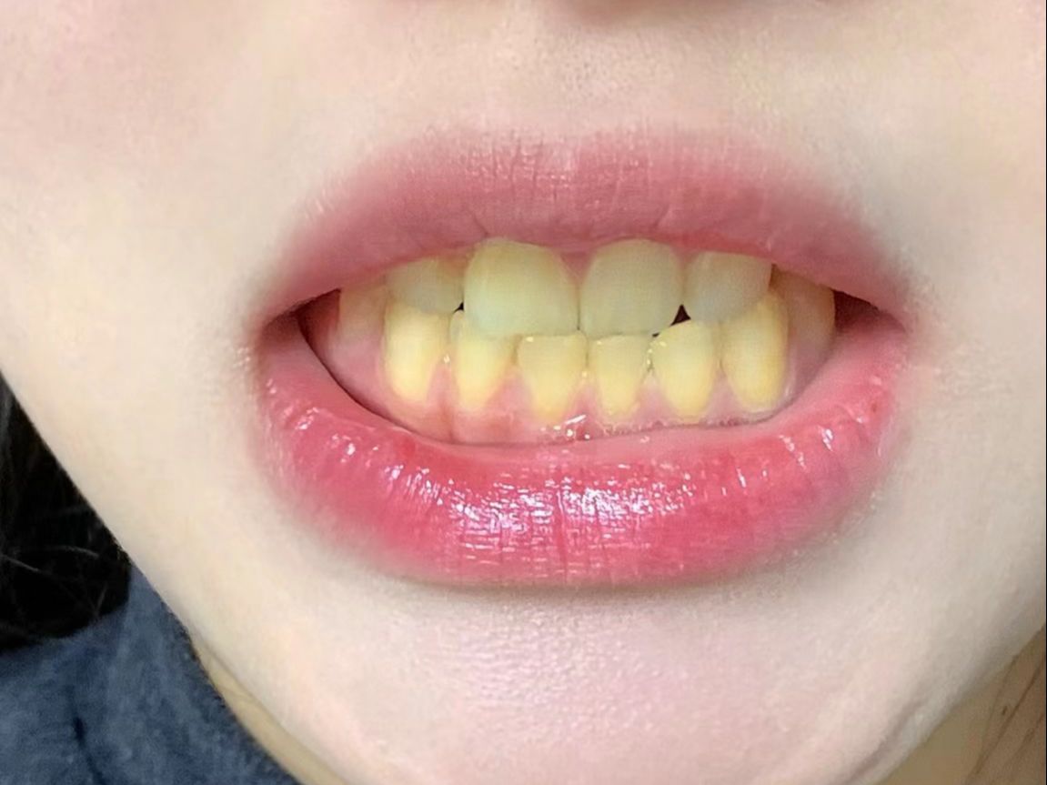 牙黄必看!用了这不起眼的小方法!口臭牙渍统统消失!