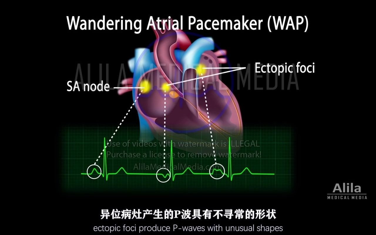 【Alila Medical Media】17.心房游走性节律和多源性房性心动过速哔哩哔哩bilibili