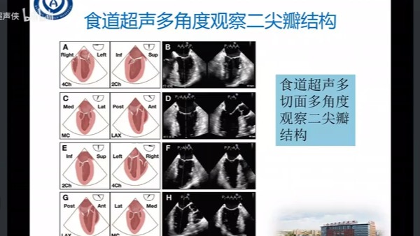 心脏彩超四腔心解剖图图片