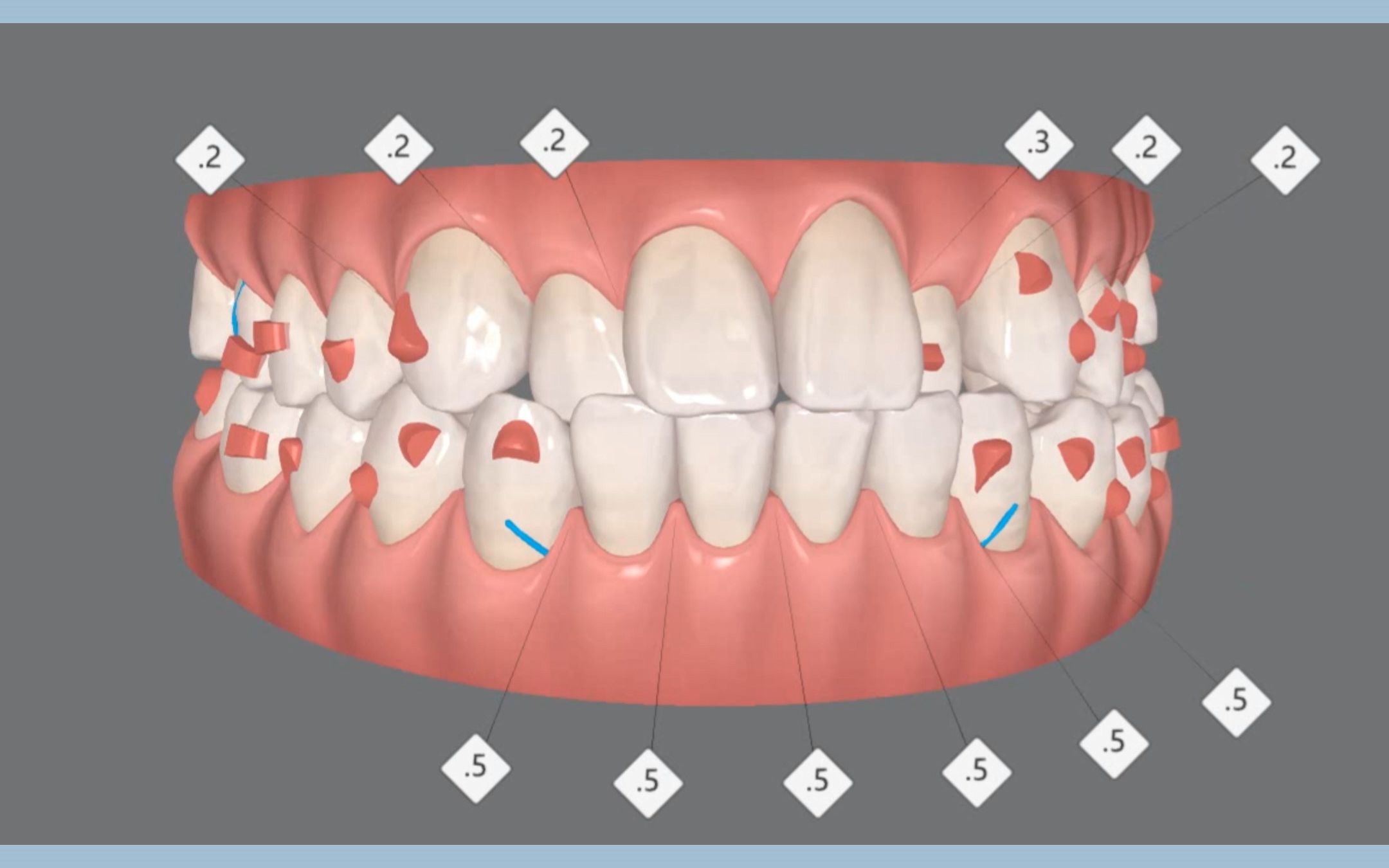 前牙反合 后牙反合