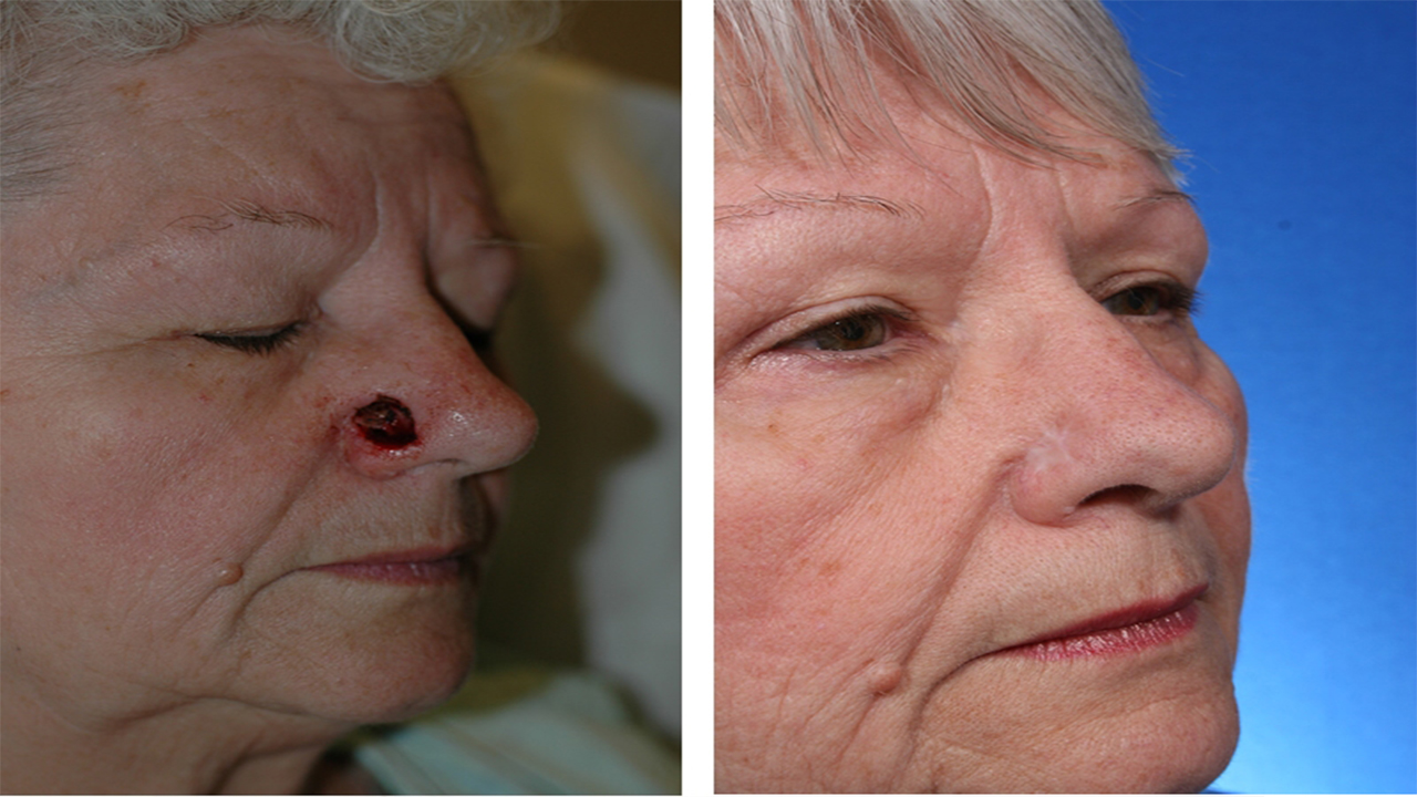 国外50岁女子因患皮肤癌鼻子直接烂成大洞