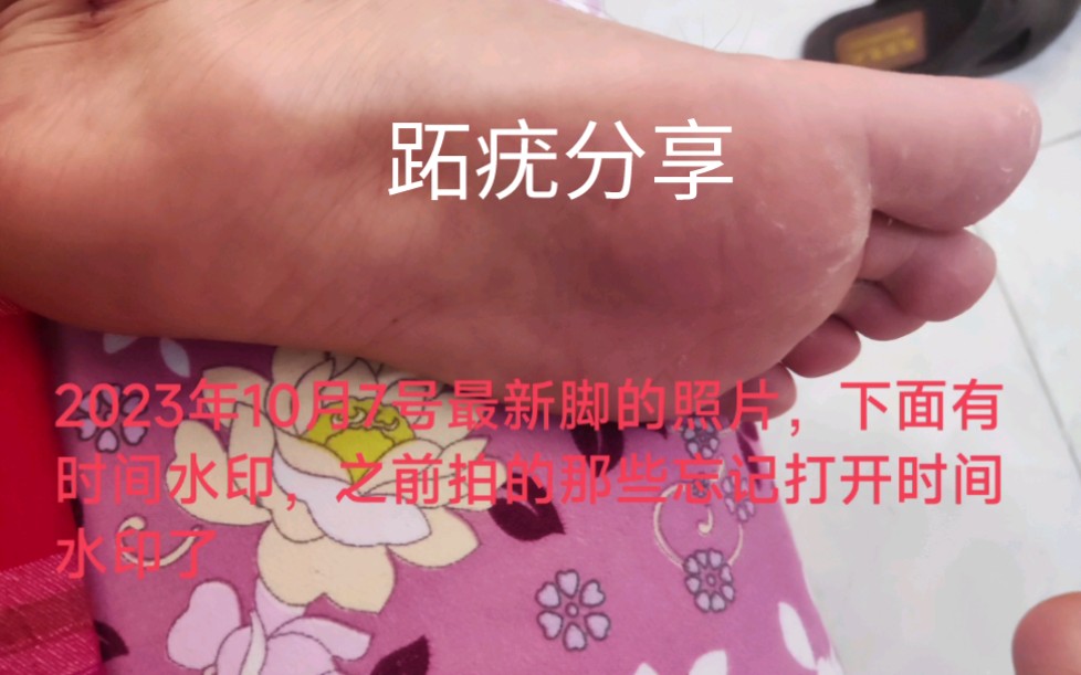 跖疣治疗全过程分享哔哩哔哩bilibili