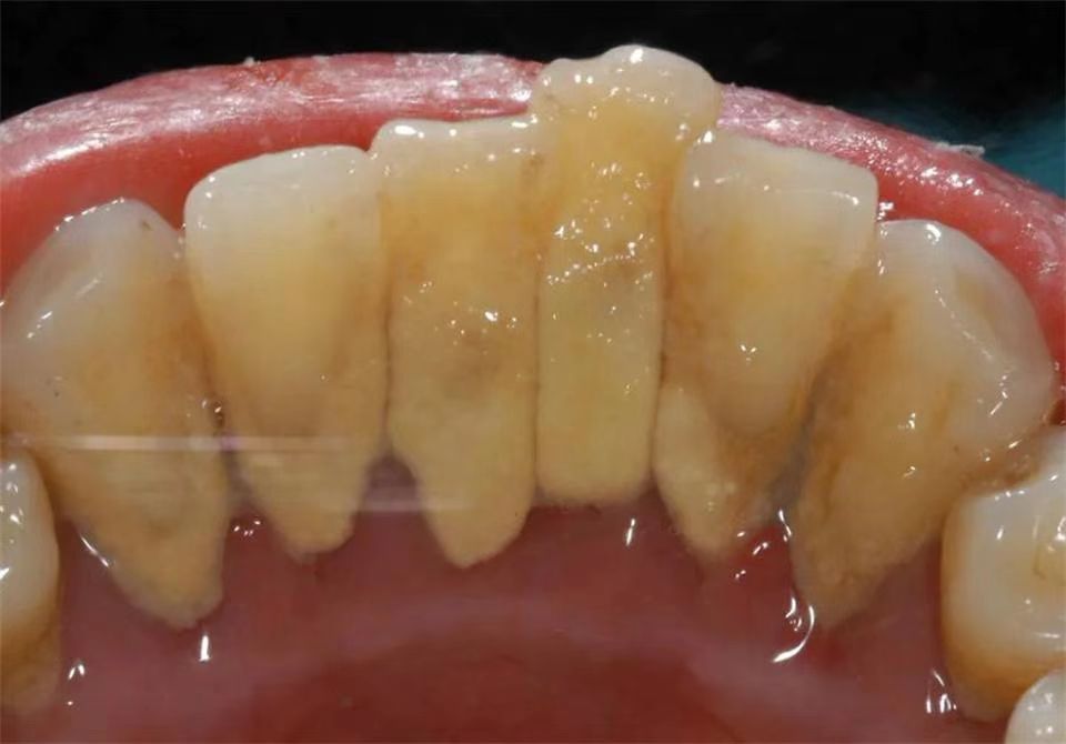 每天睡前刷刷,牙石哗啦啦全掉!