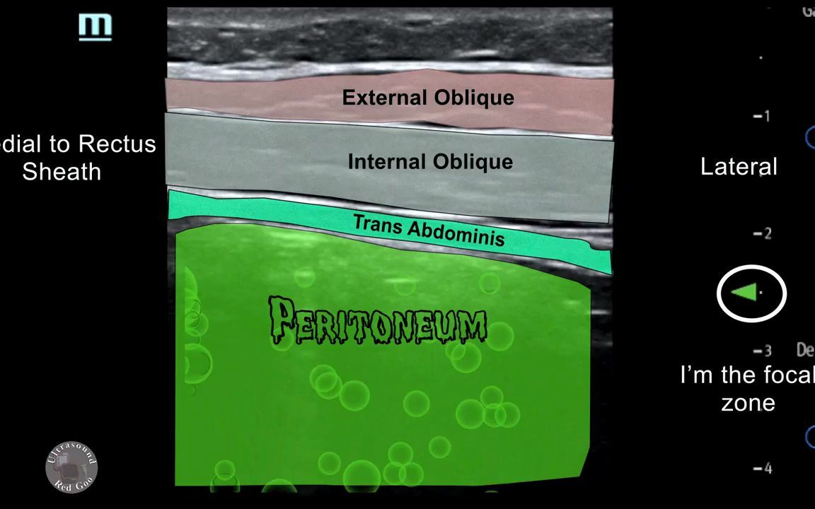 rectus sheath and tap scan