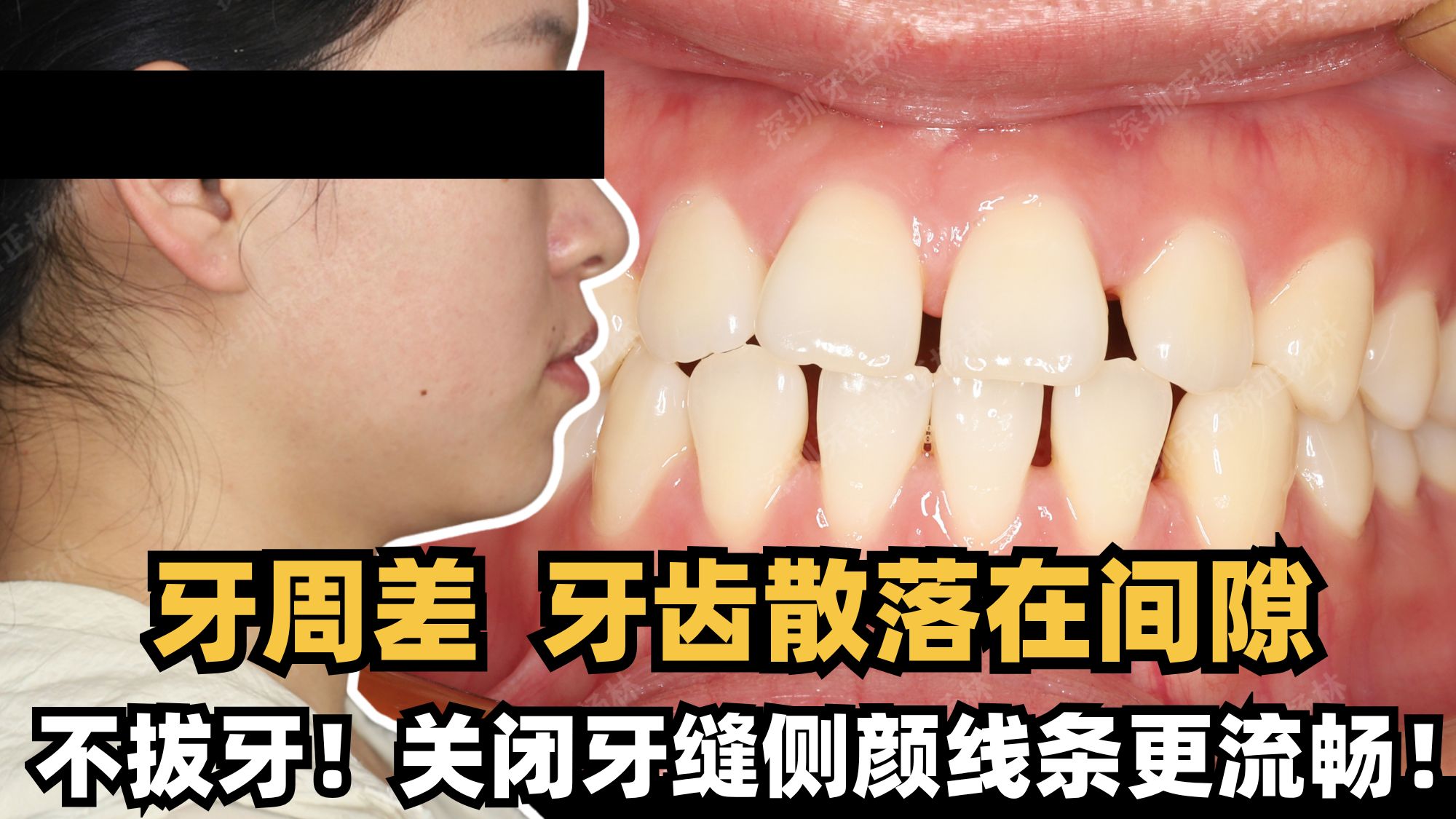 【牙缝大牙周病】牙周病不重视牙齿问题会越来越严重！