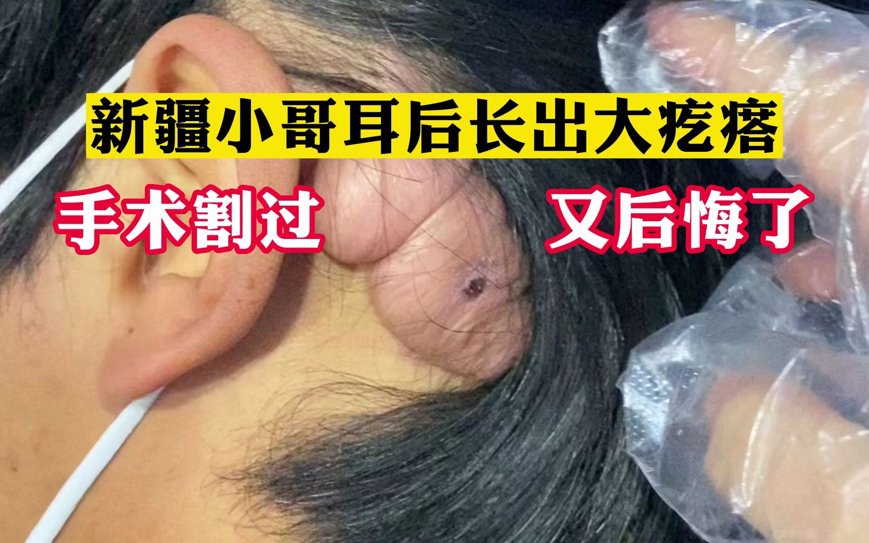 小哥耳朵后长了巨型疙瘩,他说手术割过竟长得更厉害了