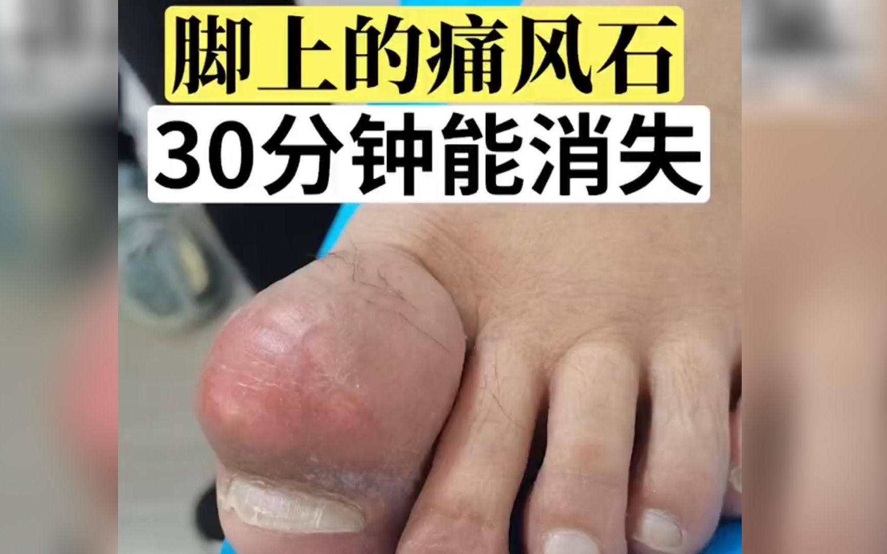 [图]痛风石，不用开刀，30分钟就能清除