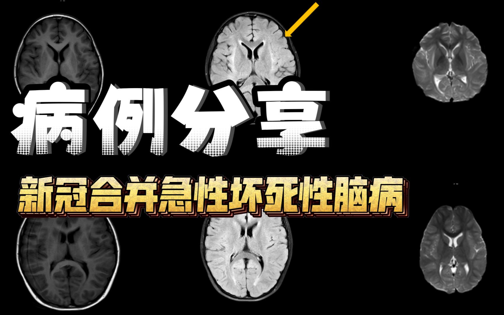 病例分享新冠合并急性坏死性脑病(ANE)哔哩哔哩bilibili