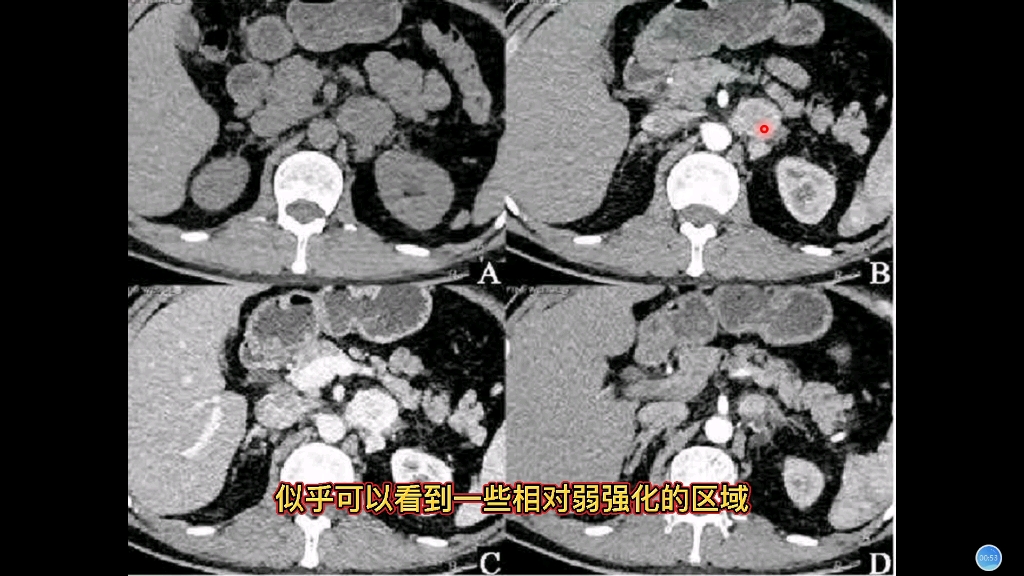 肾上腺两种疾病在CT上的不同表现,放射科医生讲解,实用易懂哔哩哔哩bilibili