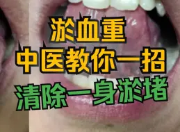 Download Video: 瘀血重，舌下筋粗紫，中医教你一招，清除一身淤堵