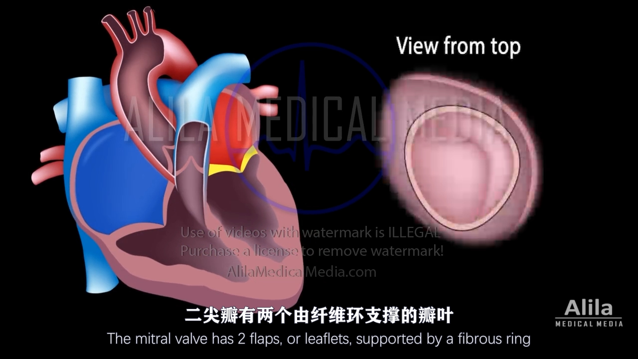 【Alila Medical Media】12.二尖瓣狭窄