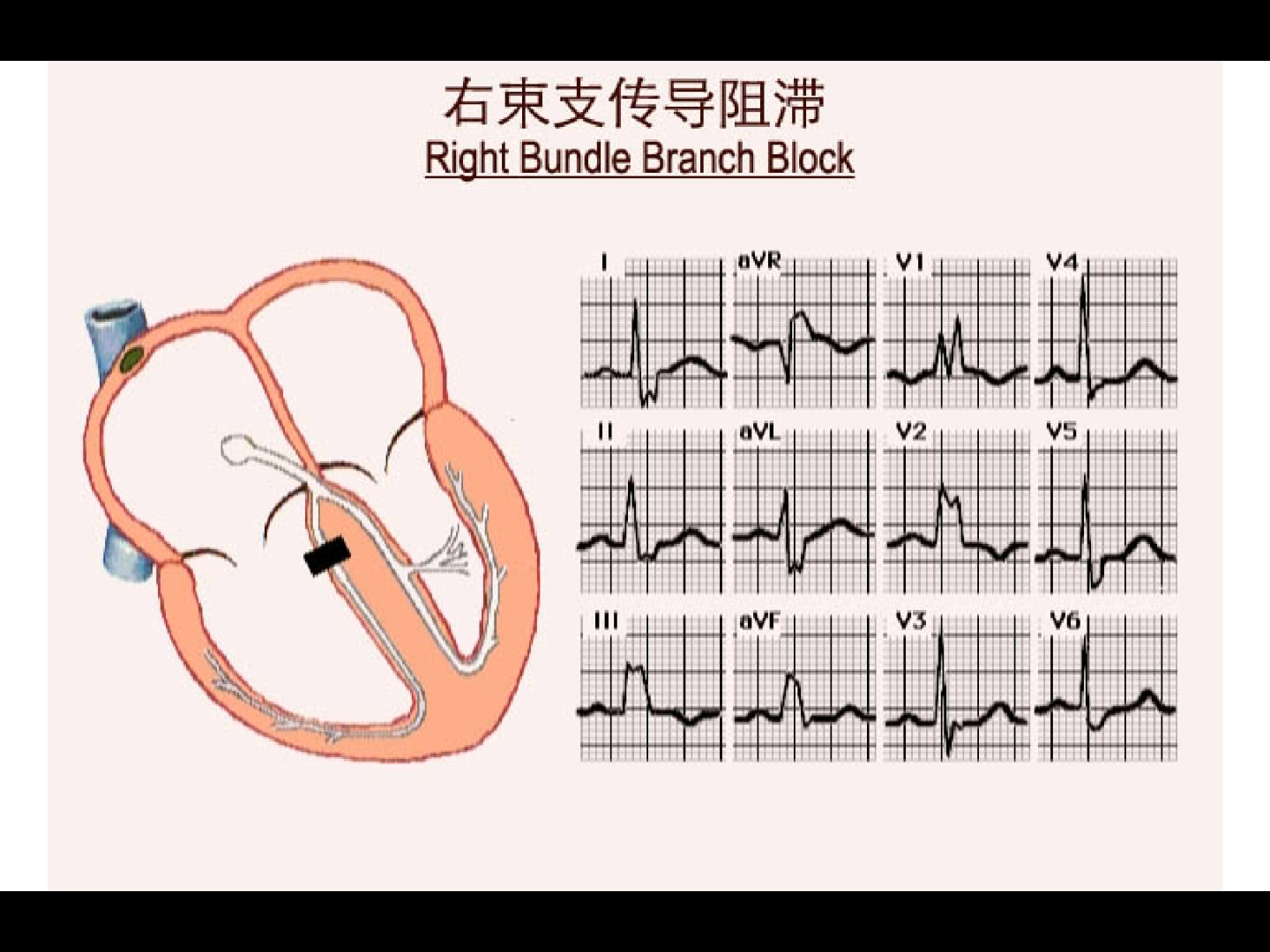 右束支传导阻滞RBBB哔哩哔哩bilibili