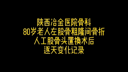 80岁老人股骨粗隆间骨折,人工股骨头置换术后,老人下地情况实录.哔哩哔哩bilibili