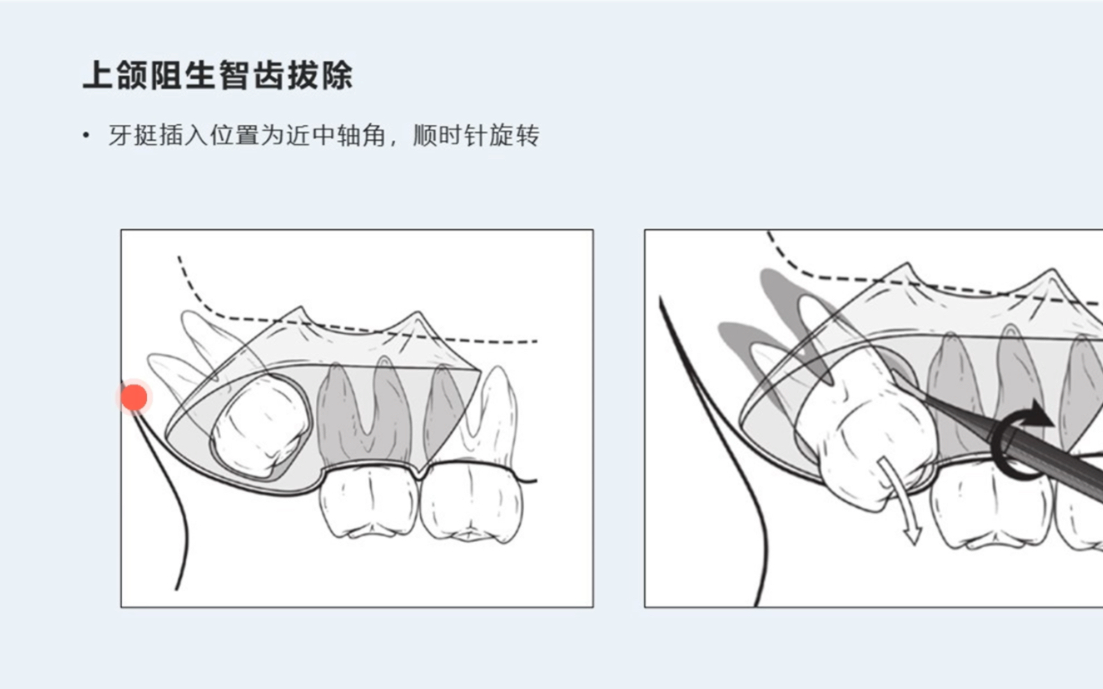 [图]刘洋 《见微知著 微创拔牙的剑与道》—水平阻生牙拔除