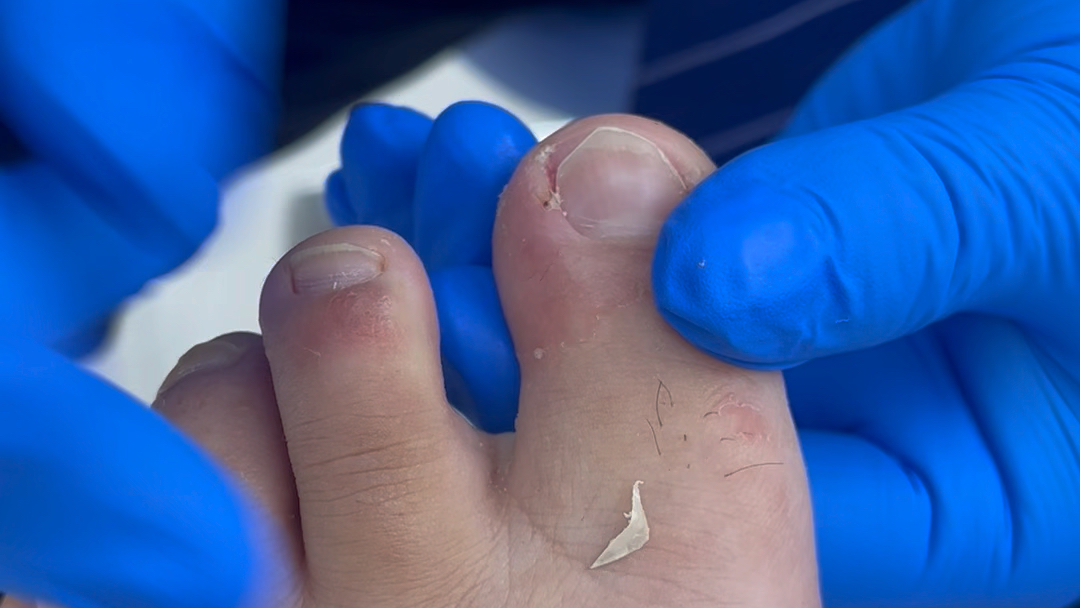 安丘治疗甲沟炎哪里好?能彻底根治,安丘商场路火狐狸对面文益生