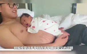 Download Video: 妊娠纹怎么去掉？