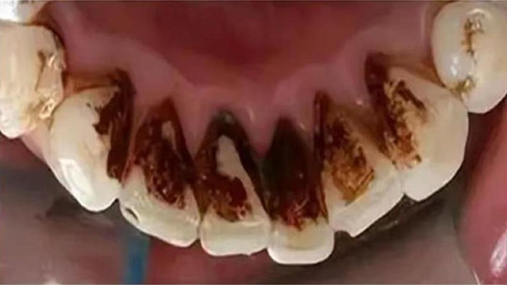 如何根治陈年烟渍!每天只需刷一刷,牙齿轻松亮白!