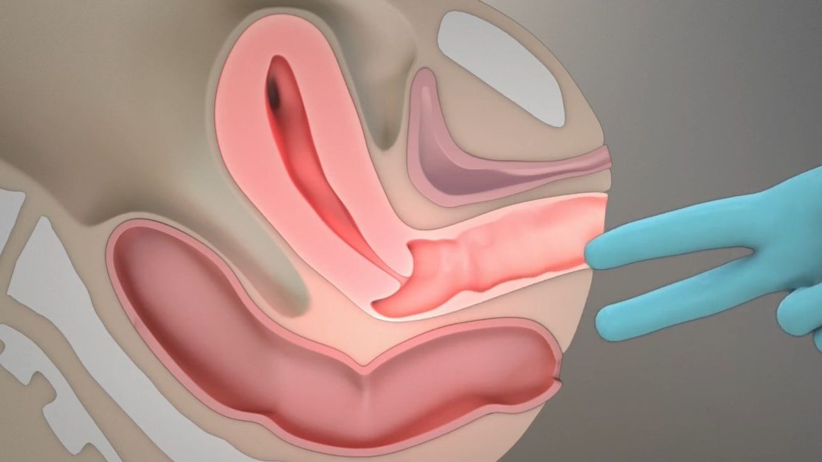 [图]女性盆腔检查 | 医学动画