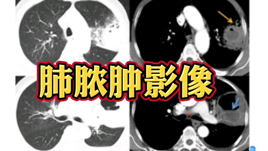 典型肺脓肿在CT上什么表现？放射科医生讲解！-影像科刘医生-影像科刘医生-哔哩哔哩视频