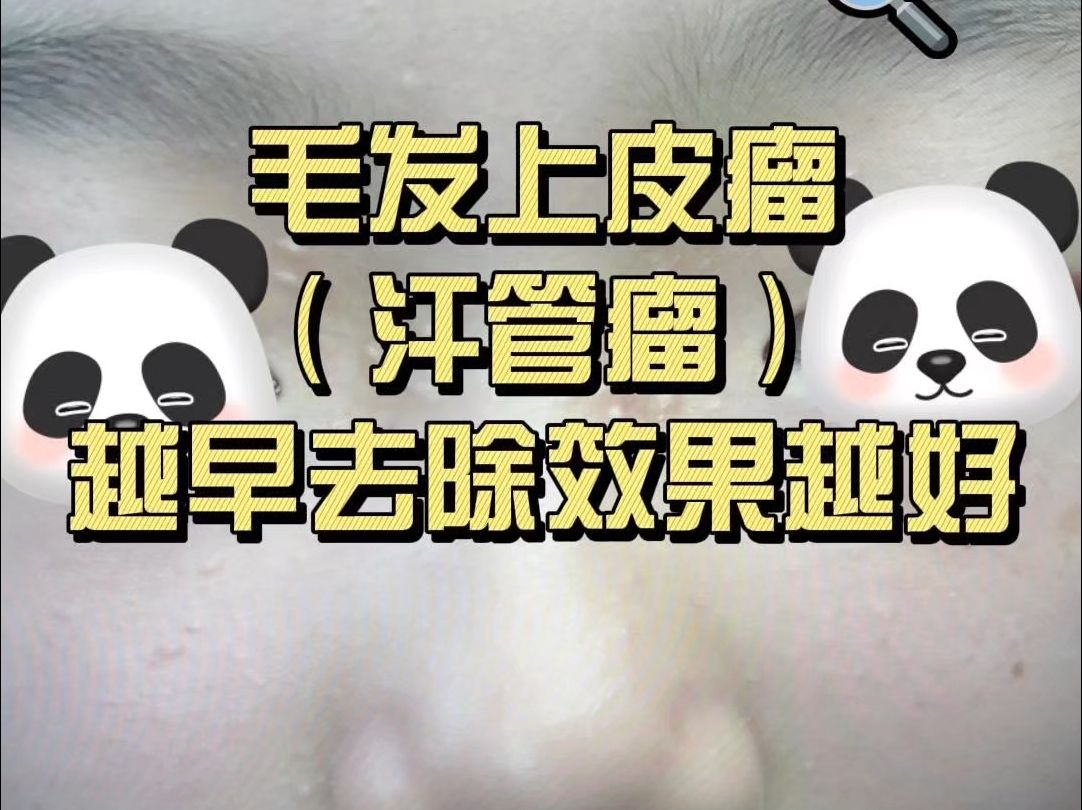 毛发上皮瘤哔哩哔哩bilibili