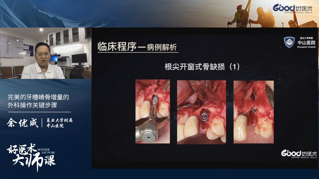 完美的牙槽嵴骨增量的外科操作关键步骤(1)(2)