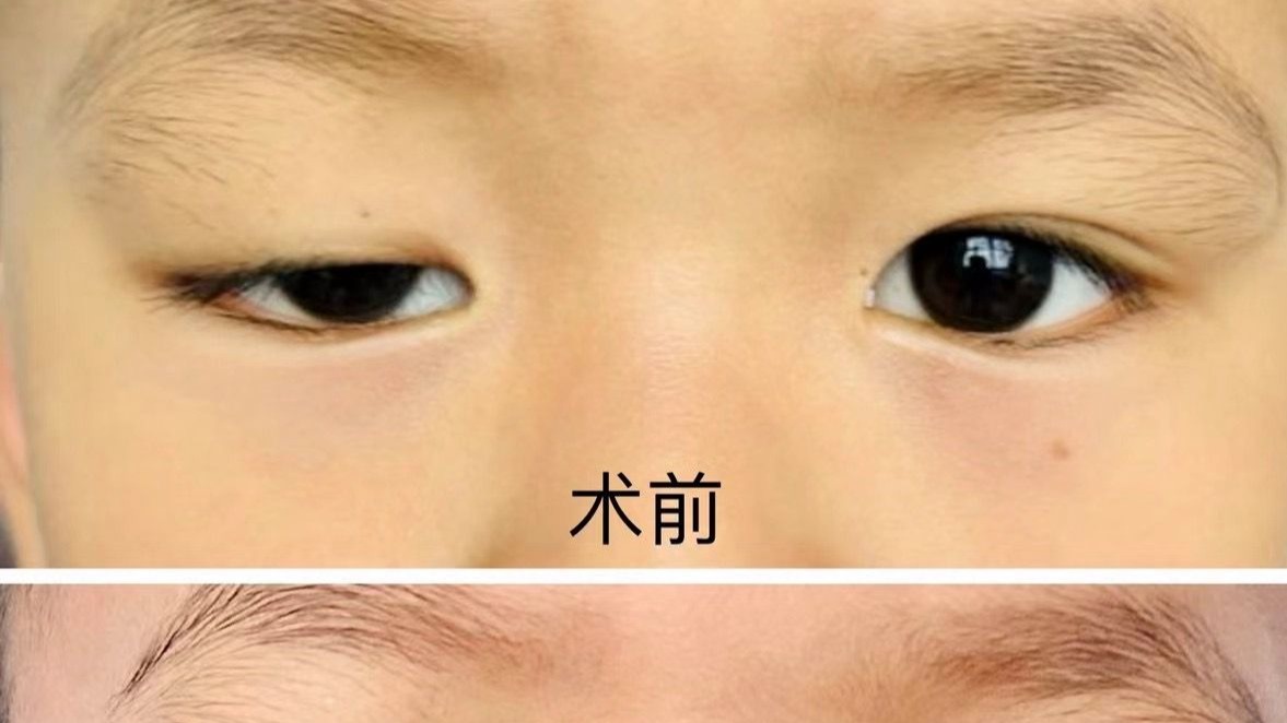 孩子眼皮遮眼,重度上睑下垂,几岁可以手术?