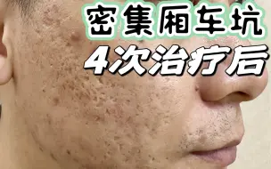 4次综合点阵激光后，感觉痘坑恢复了30%