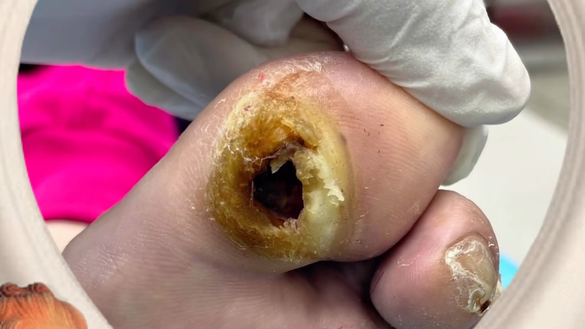 太狠了,脚丫子里面都烂空了