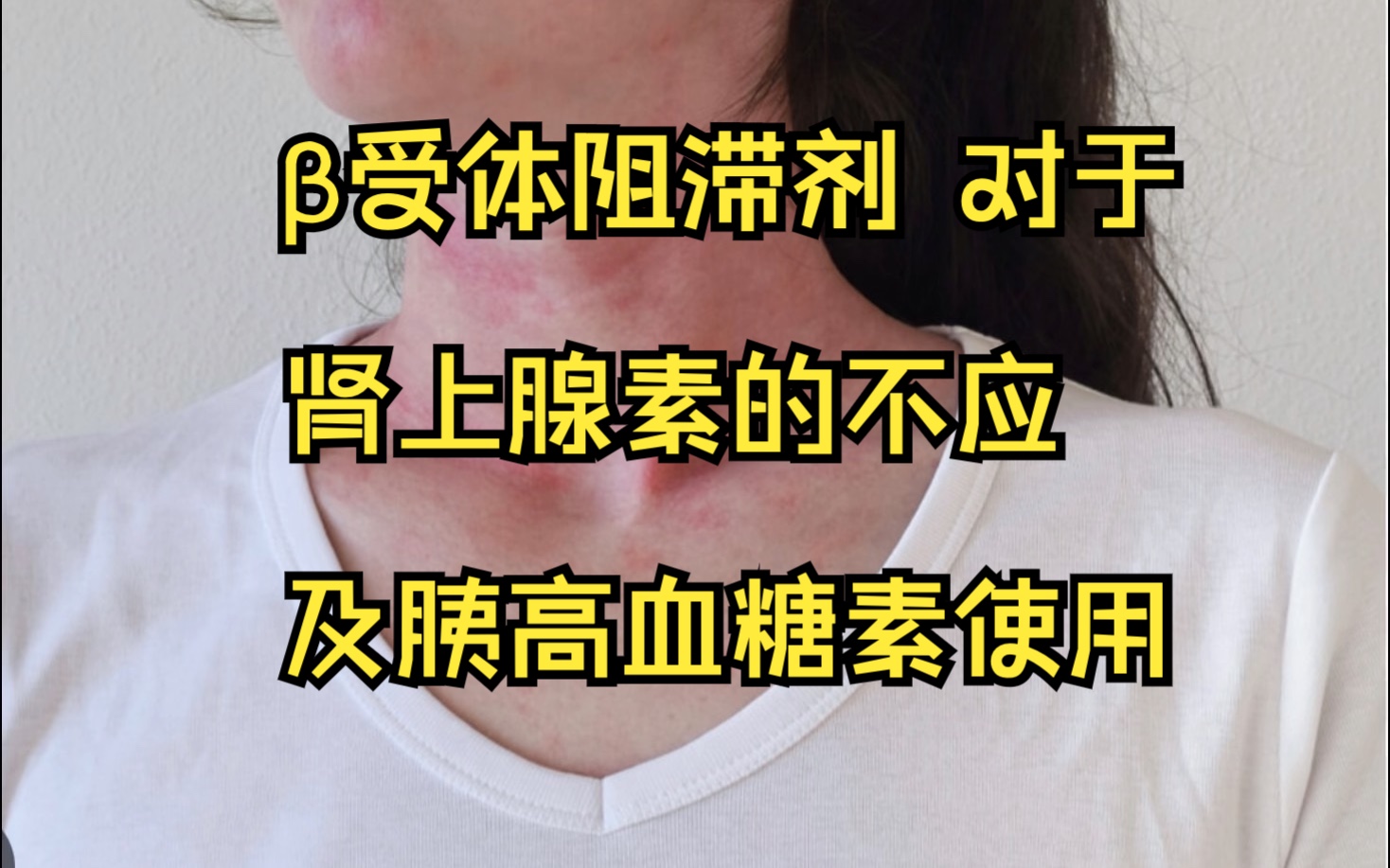 对于正在Š受体阻滞剂的患者过敏性休克时对肾上腺素不敏感问题的讨论哔哩哔哩bilibili