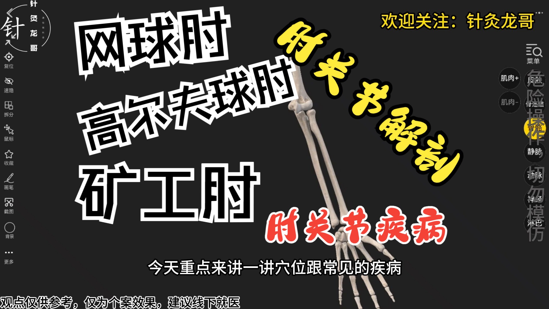 4.网球肘、高尔夫球肘、矿工肘是什么?肘关节解剖哔哩哔哩bilibili